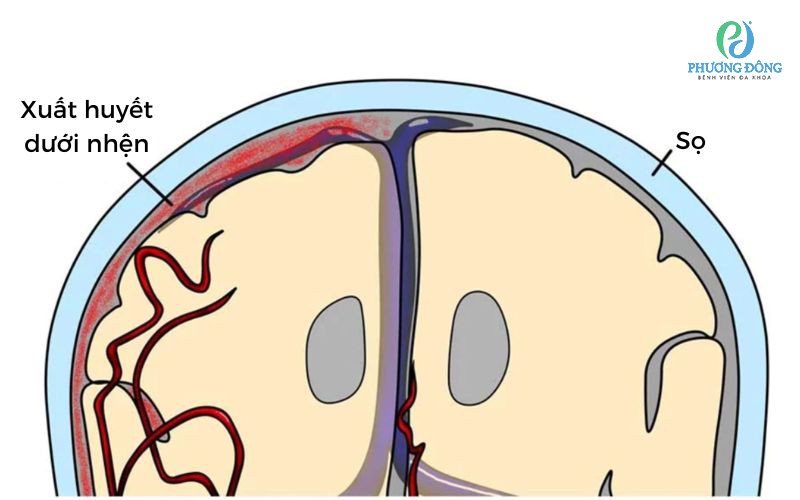 Xuất huyết dưới nhện sau chấn thương sọ não – Dấu hiệu nhỏ, hậu quả lớn